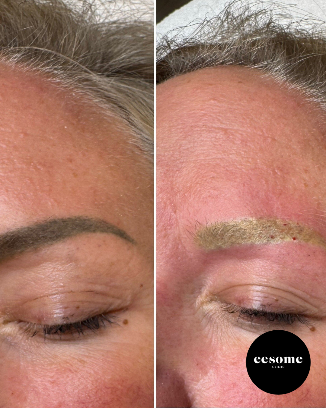 ND YAG Q Switch Picolaser